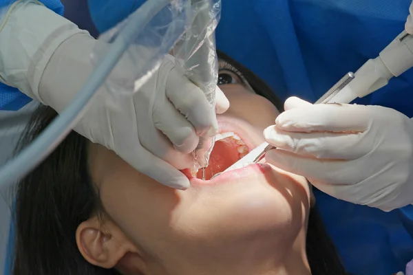 Dental Fillings in New Orleans