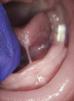 Tongue_Tie_Example_Anterior Tongue_Tie_Example_Anterior