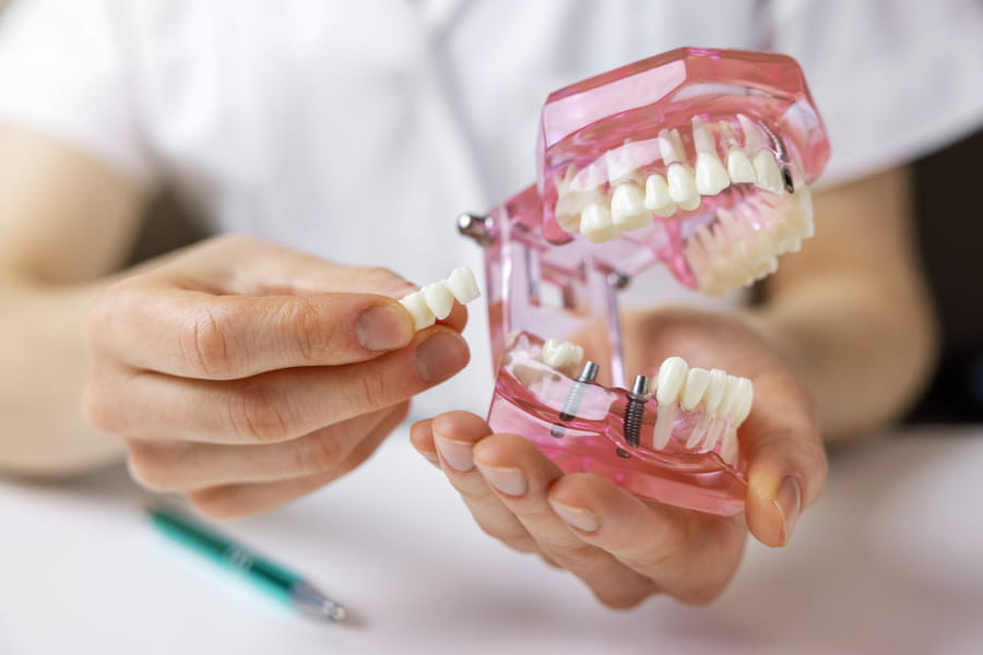 Dentist creating custom dental bridge