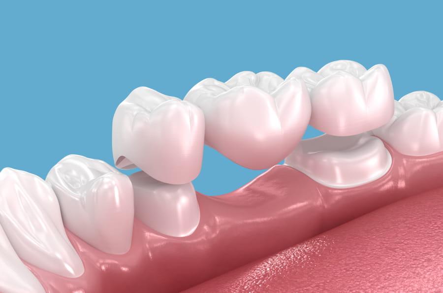 Dental bridges in New Orleans restoring missing teeth