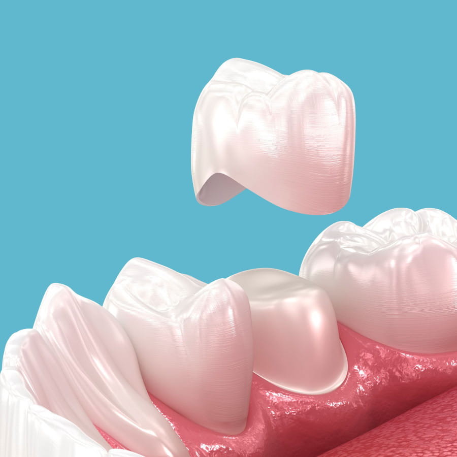 Dental Crown Services in New Orleans