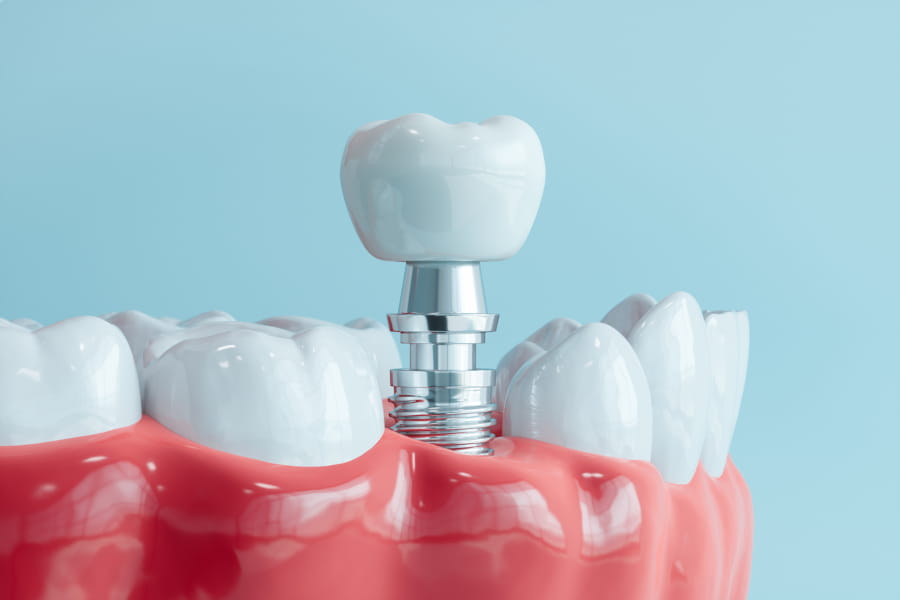 Full mouth dental implant solutions in New Orleans