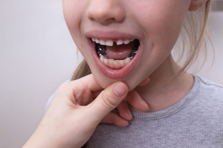 Dental crowns New Orleans restoring damaged teeth